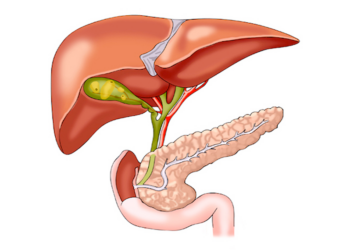 Comparaison entre cholécystectomie laparoscopique et traitement conservateur pour la lithiase biliaire symptomatique.