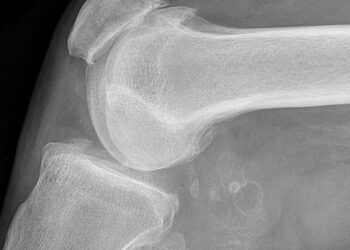 Gonarthrose, la thérapie cellulaire en question
