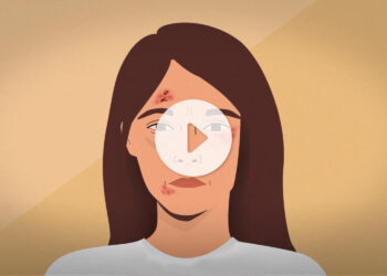 Alma a le sentiment que son eczéma contrôle sa vie. Suivez le parcours d'Alma et découvrez comment la dermatite atopique affecte sa vie quotidienne