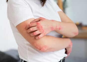 Bimekizumab, de quoi satisfaire dermatologues, rhumatologues et patients