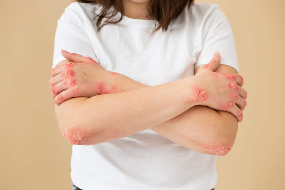 Psoriasis, bilan succinct de vingt ans de progrès