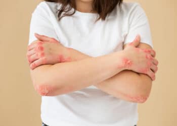 De vooruitgang in het targeten van interleukinen en het begrijpen van het epigenetisch geheugen maakt langdurige remissie bij psoriasis mogelijk.