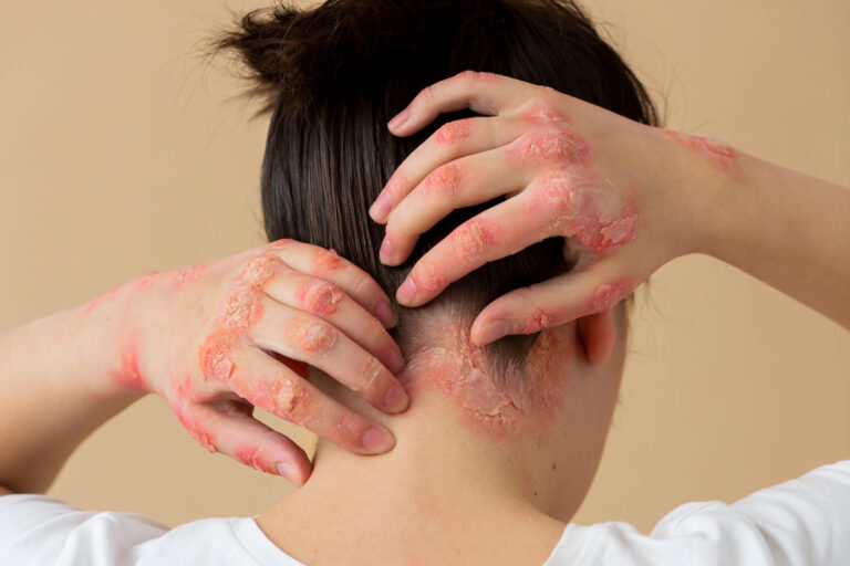 Psoriasis cuir chevelu
