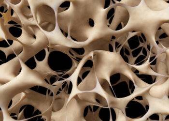 Effets systémiques de la corticothérapie locale&nbsp;: comment l'absorption cutanée prolongée de corticoïdes topiques altère la densité osseuse et augmente le risque de fractures ostéoporotiques majeures.