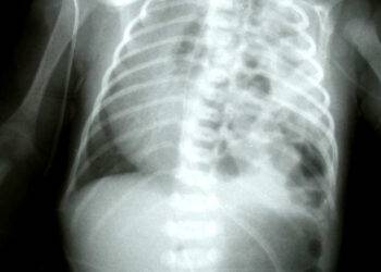 La régulation de l'acétylation des histones par le gène SIN3A offre de nouvelles perspectives thérapeutiques pour traiter l'hypoplasie pulmonaire liée à la hernie diaphragmatique congénitale.