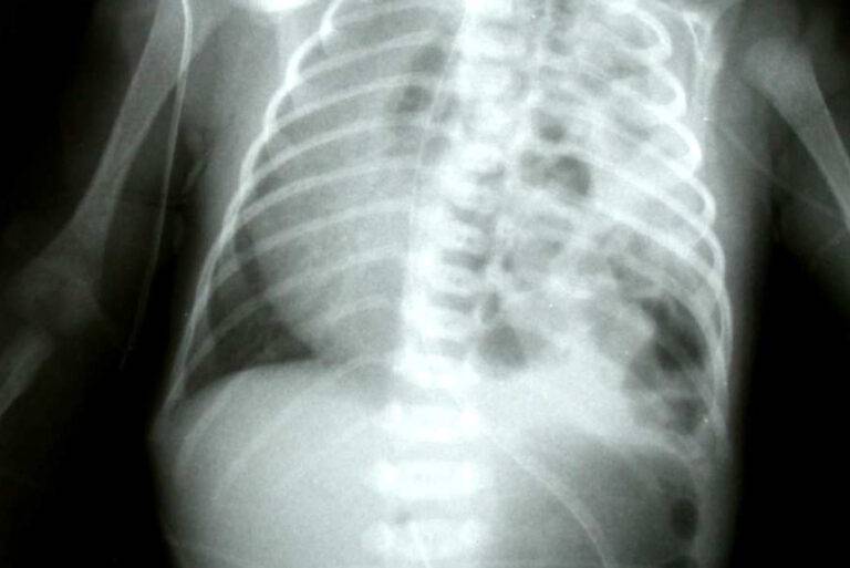 Hernie diaphragmatique congénitale