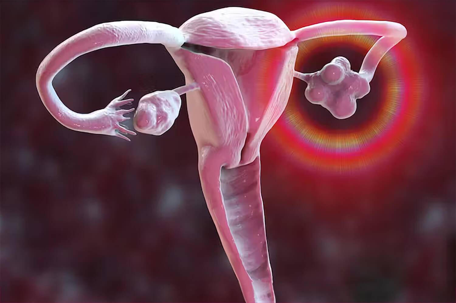 Syndrome des ovaires polykystiques, il n'y a pas que des problèmes gynécologiques à prendre en charge