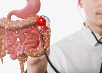 Colon irritable
