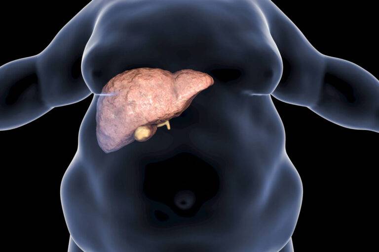 De la NAFLD à la MASLD