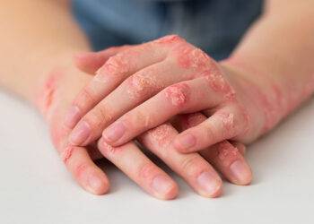 Les biothérapies peuvent-elles empêcher la survenue d'un rhumatisme psoriasique
