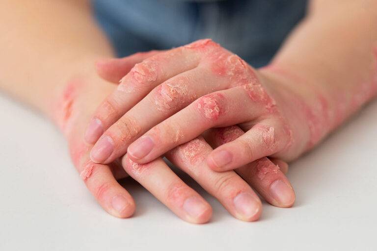 Les biothérapies peuvent-elles empêcher la survenue d'un rhumatisme psoriasique