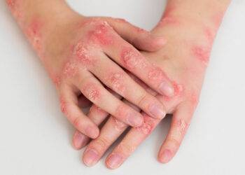 Rhumatisme psoriasique et risque cardiovasculaire