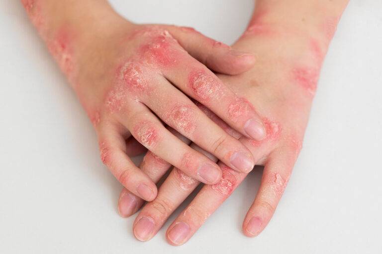 Rhumatisme psoriasique et risque cardiovasculaire