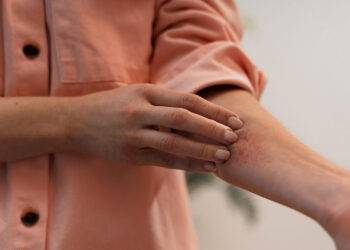 Dermatite atopique, haro sur le sel