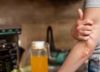 psoriasis et la BPCO