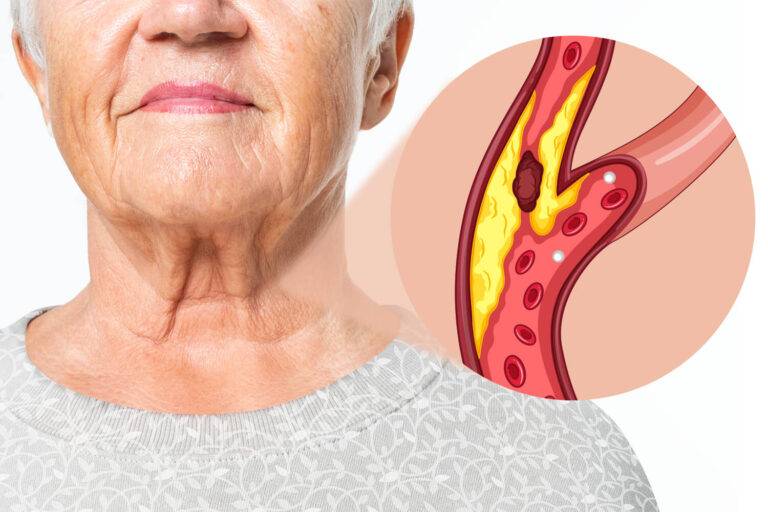 Echographie vasculaire pour mesurer les plaques d’athérosclérose