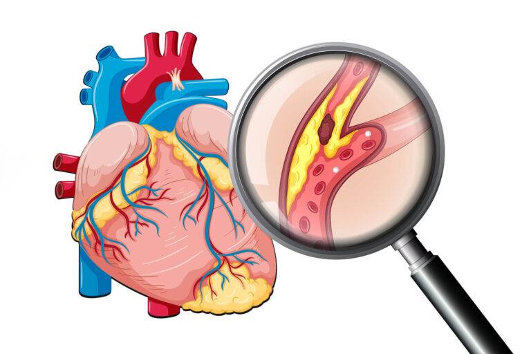 Le diabète de type 2 fragilise les plaques d'athérosclérose, soulignant l'importance d'un contrôle strict des facteurs de risque cardiovasculaire.