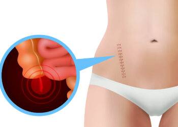 Antibiothérapie IV ou chirurgie en cas d'appendicite aiguë de l'adulte?