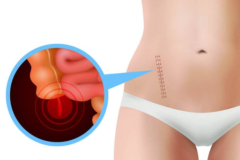 Antibiothérapie IV ou chirurgie en cas d'appendicite aiguë de l'adulte?
