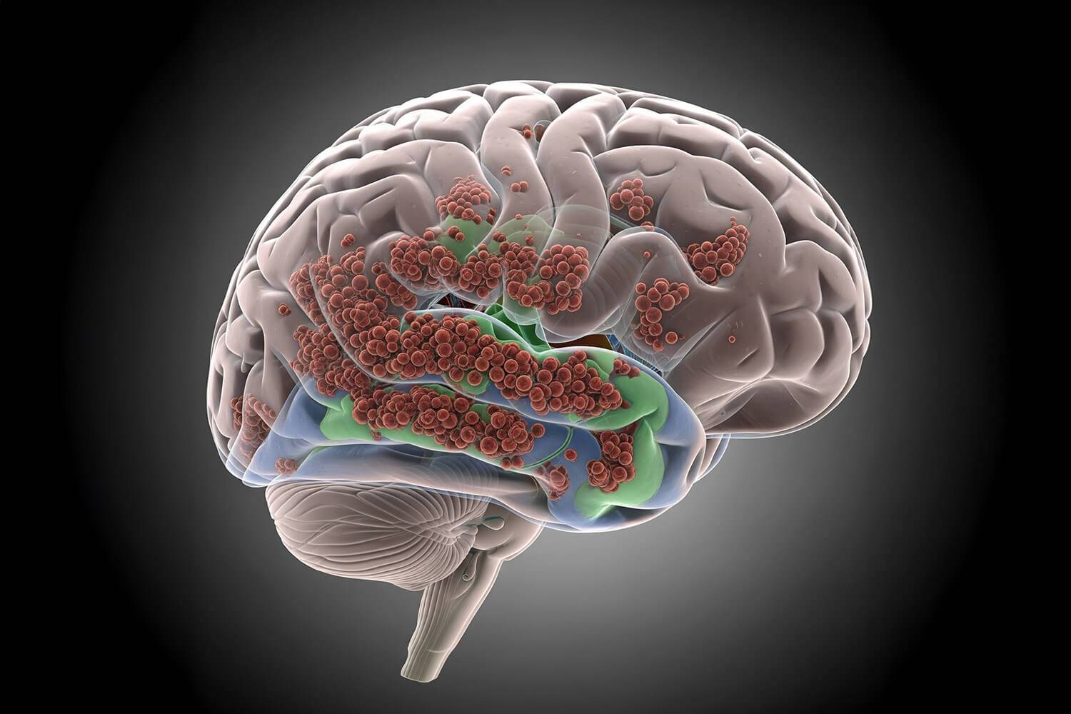 Démence : Parkinson et corps de Lewy, deux visages d’une même maladie ?