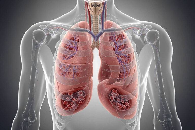 Drépanocytose&nbsp;: le complément impliqué dans le syndrome thoracique aigu&nbsp;?