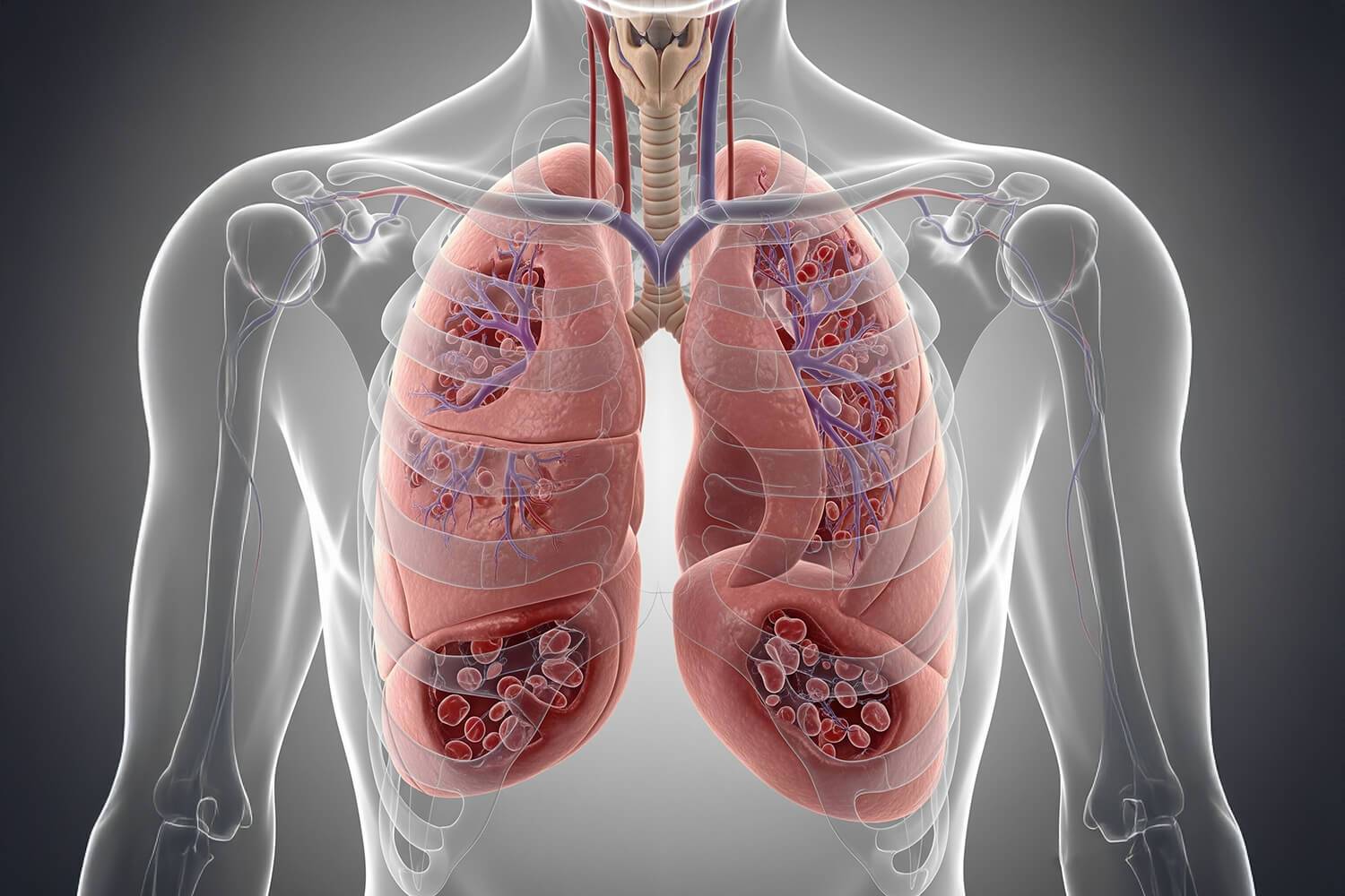 Drépanocytose : le complément impliqué dans le syndrome thoracique aigu ?