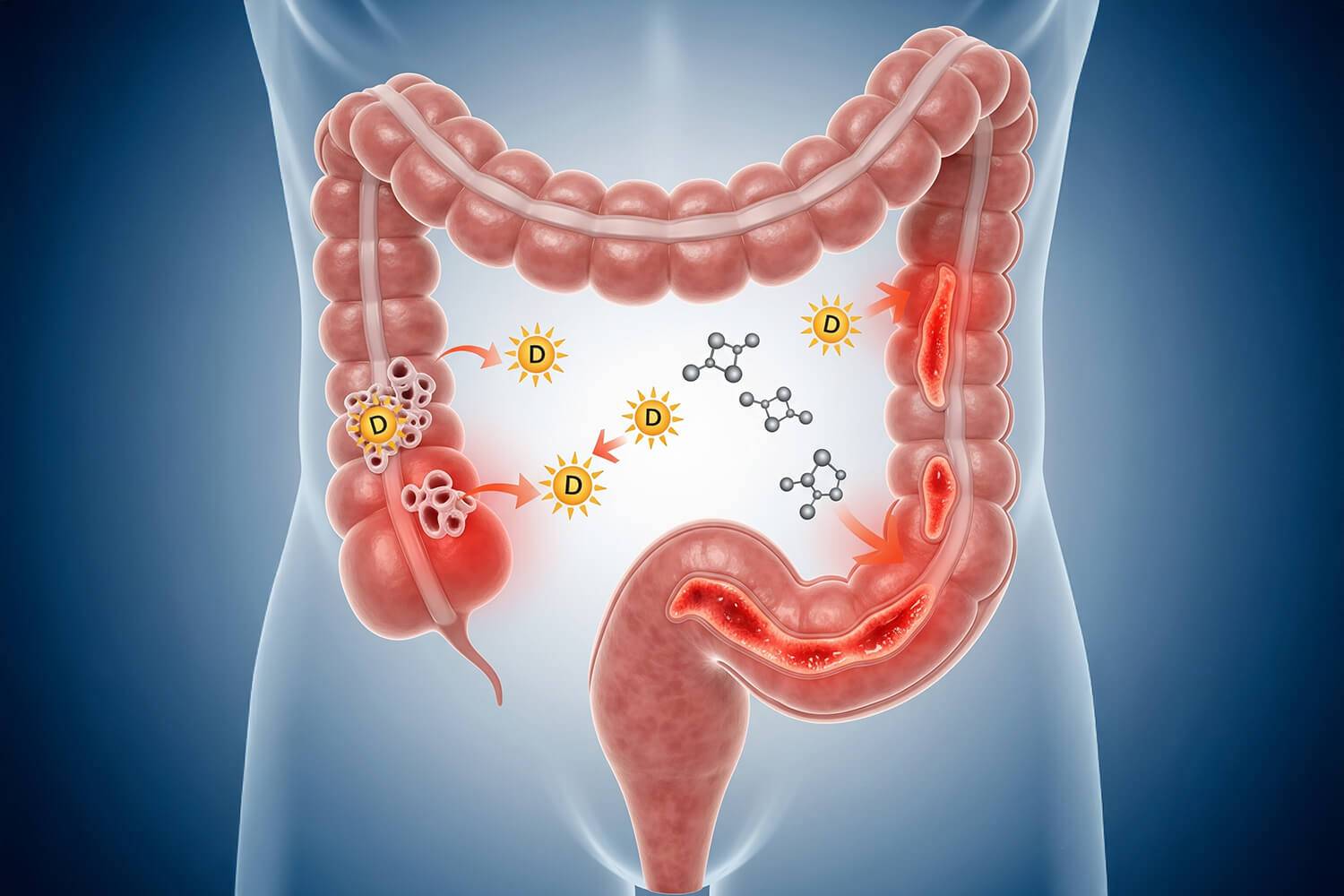Vitamine D : un atout potentiel contre les maladies inflammatoires du côlon.