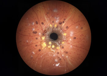 Case-control studie naar het verband tussen diabetes type 2, psoriasis en een verhoogd risico op het ontwikkelen van diabetische retinopathie.