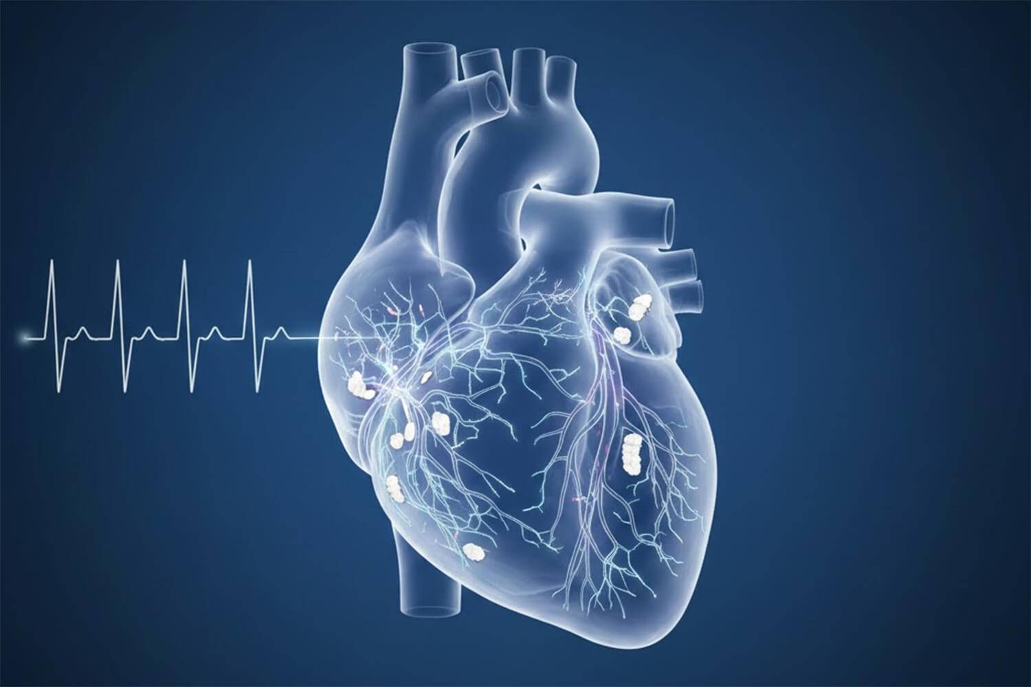 Étude sur l'impact de l'arrêt des anticoagulants oraux sur les risques thrombo-emboliques et hémorragiques après ablation de la FA