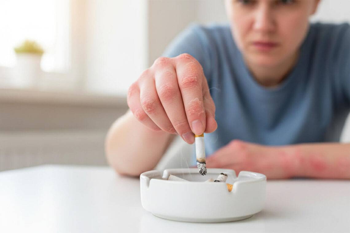 Le sevrage tabagique combiné au contrôle du poids réduit significativement le risque de développer différentes formes de psoriasis