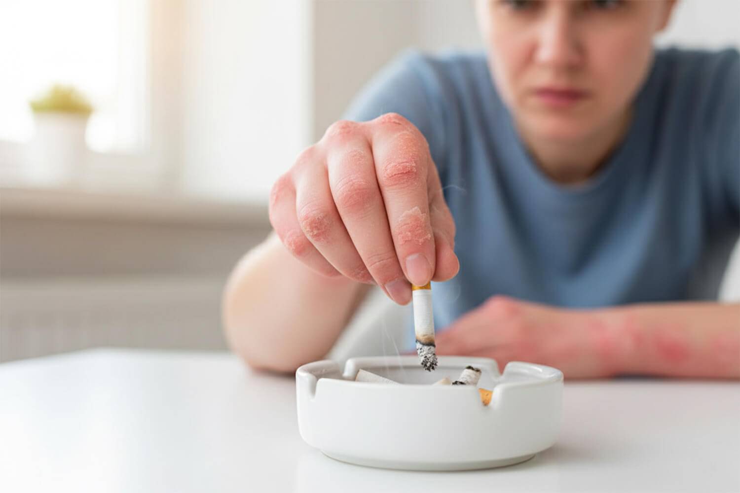 Le sevrage tabagique combiné au contrôle du poids réduit significativement le risque de développer différentes formes de psoriasis