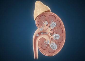 Ontdekking van bacteriën en bacteriële biofilms geïntegreerd in de structuur van calciumoxalaat-nierstenen.