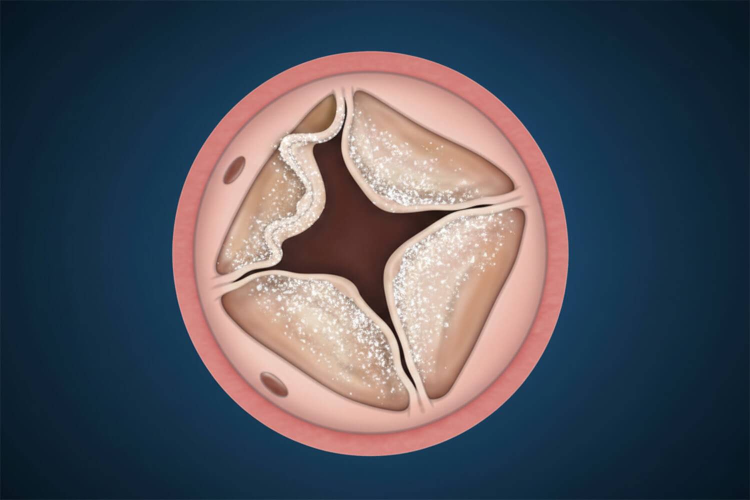 Een rekbare hartklepprothese van nitinol past zich aan de hartgroei aan om heroperaties bij kinderen te beperken.