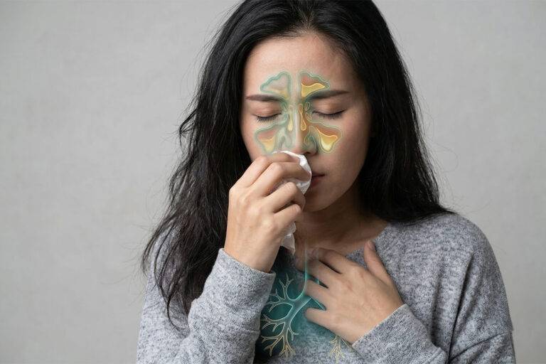 Chronische rhino-sinusitis bij astmapatiënten is geassocieerd met een toename van ziekenhuisopnames en het gebruik van systemische corticosteroïden.