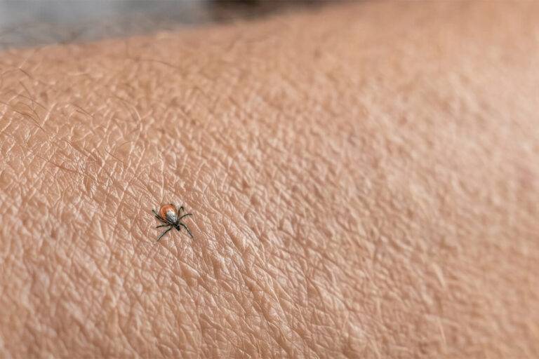 Techniek voor het handmatig verwijderen van een teek op de huid om infecties te voorkomen.