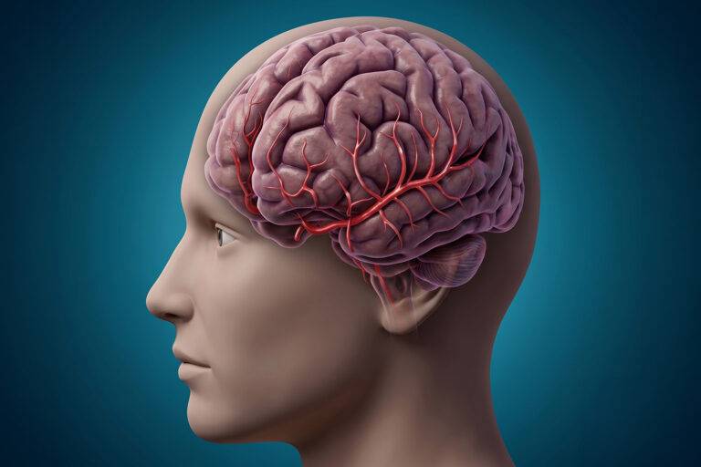 Onderzoek naar de mechanismen van een lacunair infarct: hoe cerebrale microangiopathie en vaatverwijding leiden tot stille beroertes en cognitieve achteruitgang.
