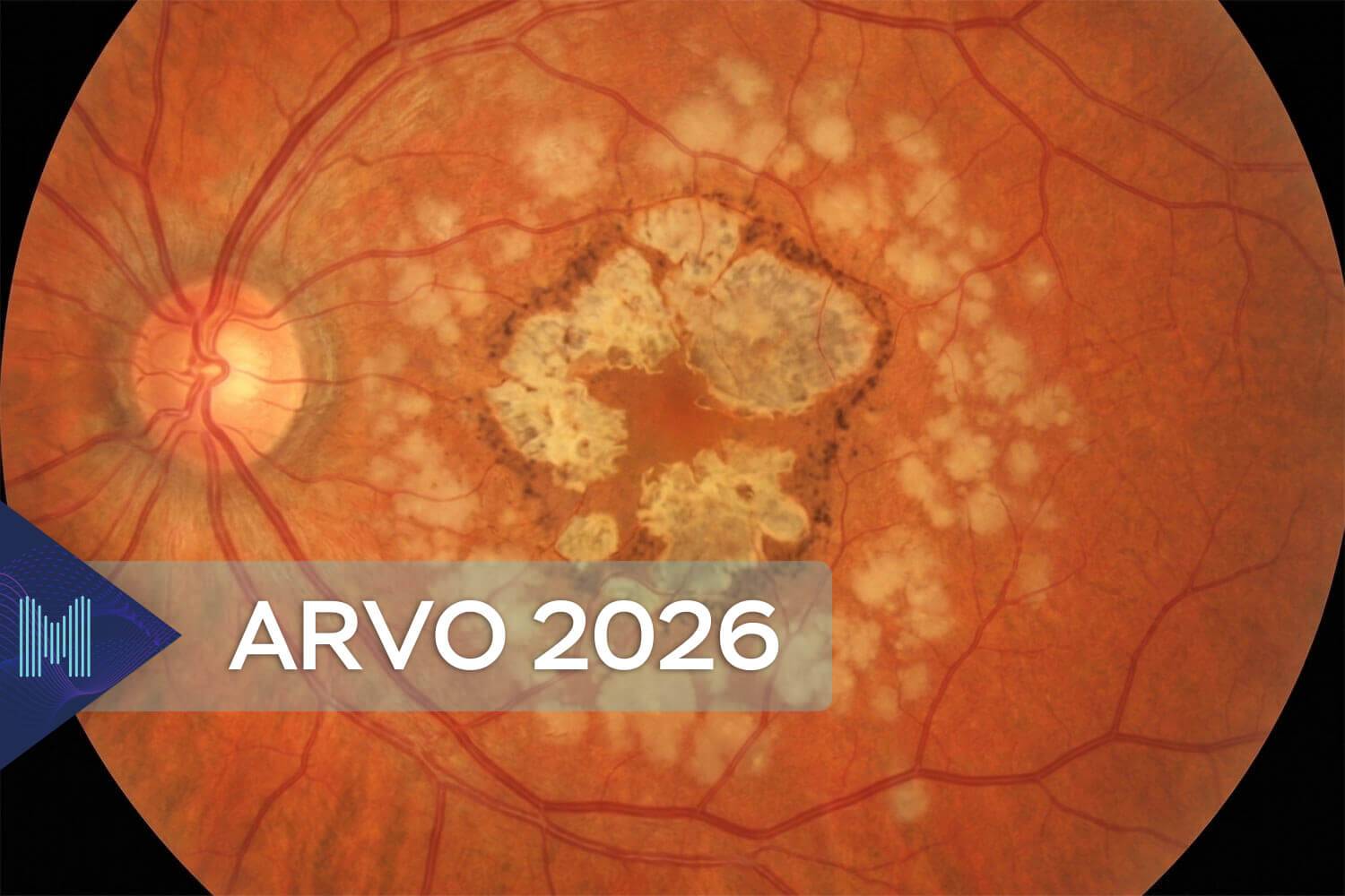 Impact du métabolisme lipidique sur la vision&nbsp;: comment la gestion du cholestérol LDL protège la micro-vascularisation rétinienne et préserve l'acuité visuelle dans la DMLA.