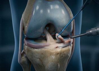 Évaluation à long terme de la chirurgie du genou&nbsp;: comment l'étude FIDELITY démontre qu'une méniscectomie partielle par arthroscopie aggrave l'évolution radiologique par rapport à un placebo.