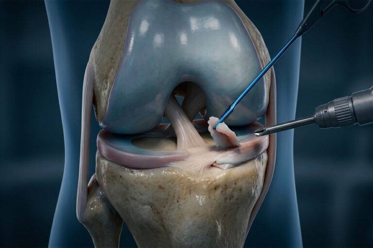 Évaluation à long terme de la chirurgie du genou&nbsp;: comment l'étude FIDELITY démontre qu'une méniscectomie partielle par arthroscopie aggrave l'évolution radiologique par rapport à un placebo.