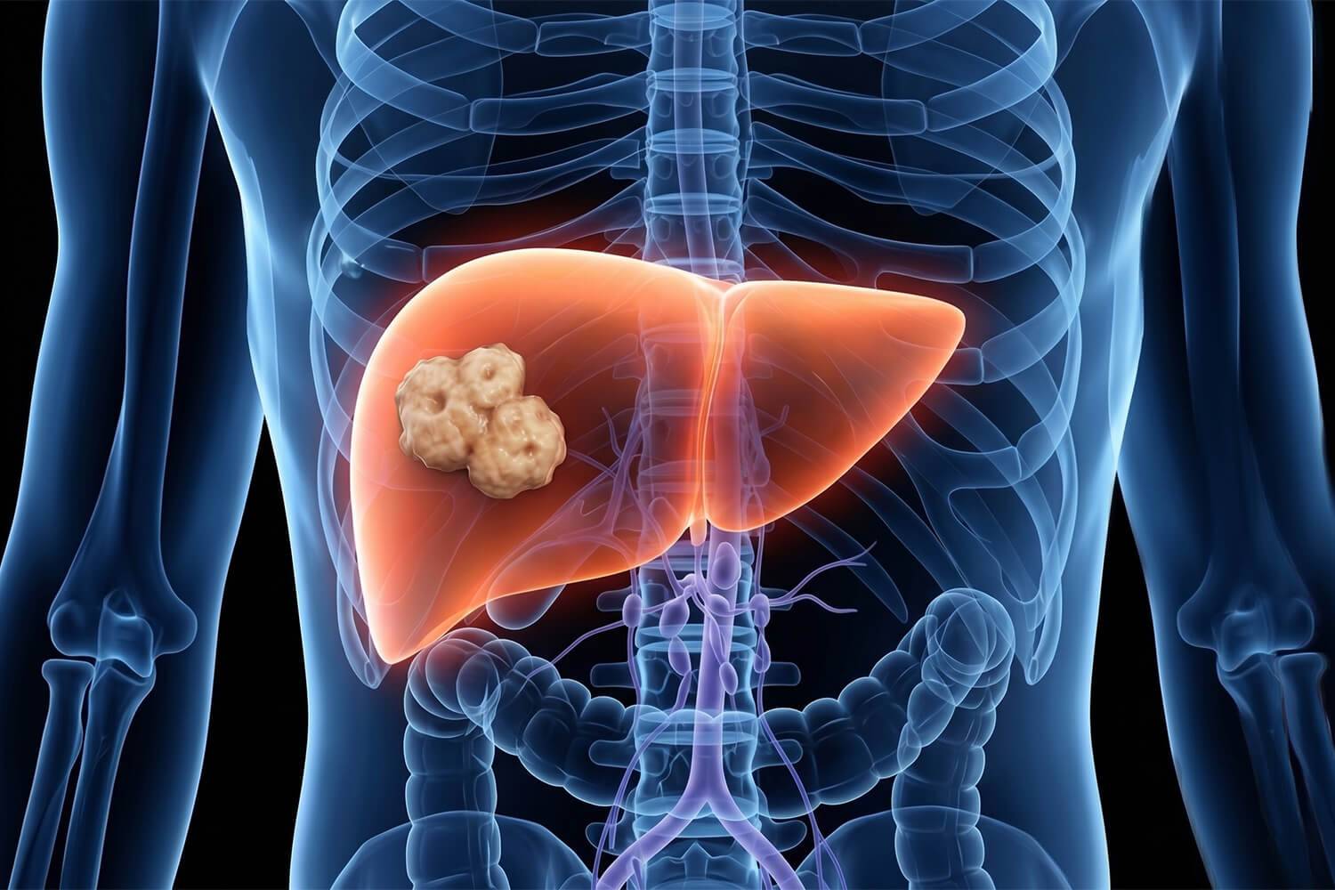 Oncologie en hepatologie: studie van het VIB-KU Leuven naar de rol van leversteatose bij de ontwikkeling van levermetastasen bij darmkanker.