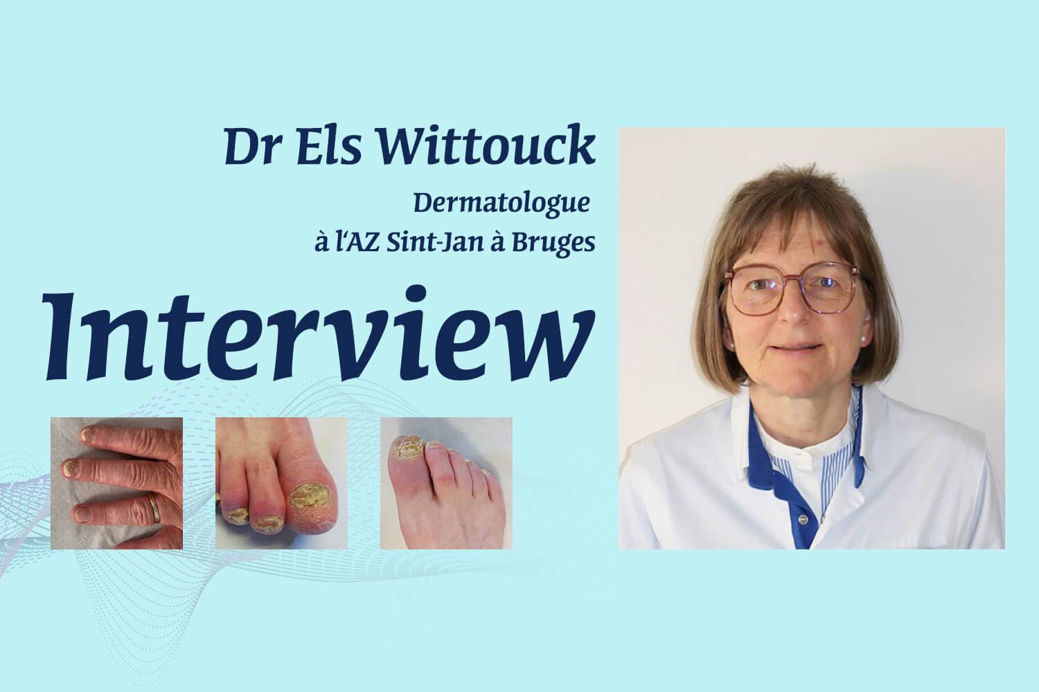 Dermatologie et rhumatologie&nbsp;: étude de cas illustrant la régression du psoriasis unguéal et l'inhibition des interleukines 17A et 17F par le bimekizumab.