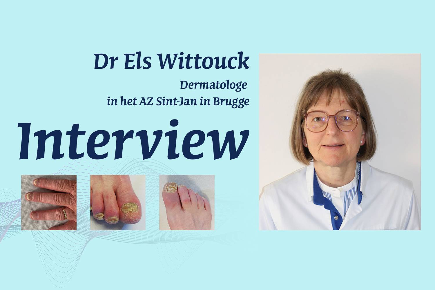Dermatologie en reumatologie: casusweergave van het herstel van nagelpsoriasis en de remming van interleukine 17A en 17F door bimekizumab.