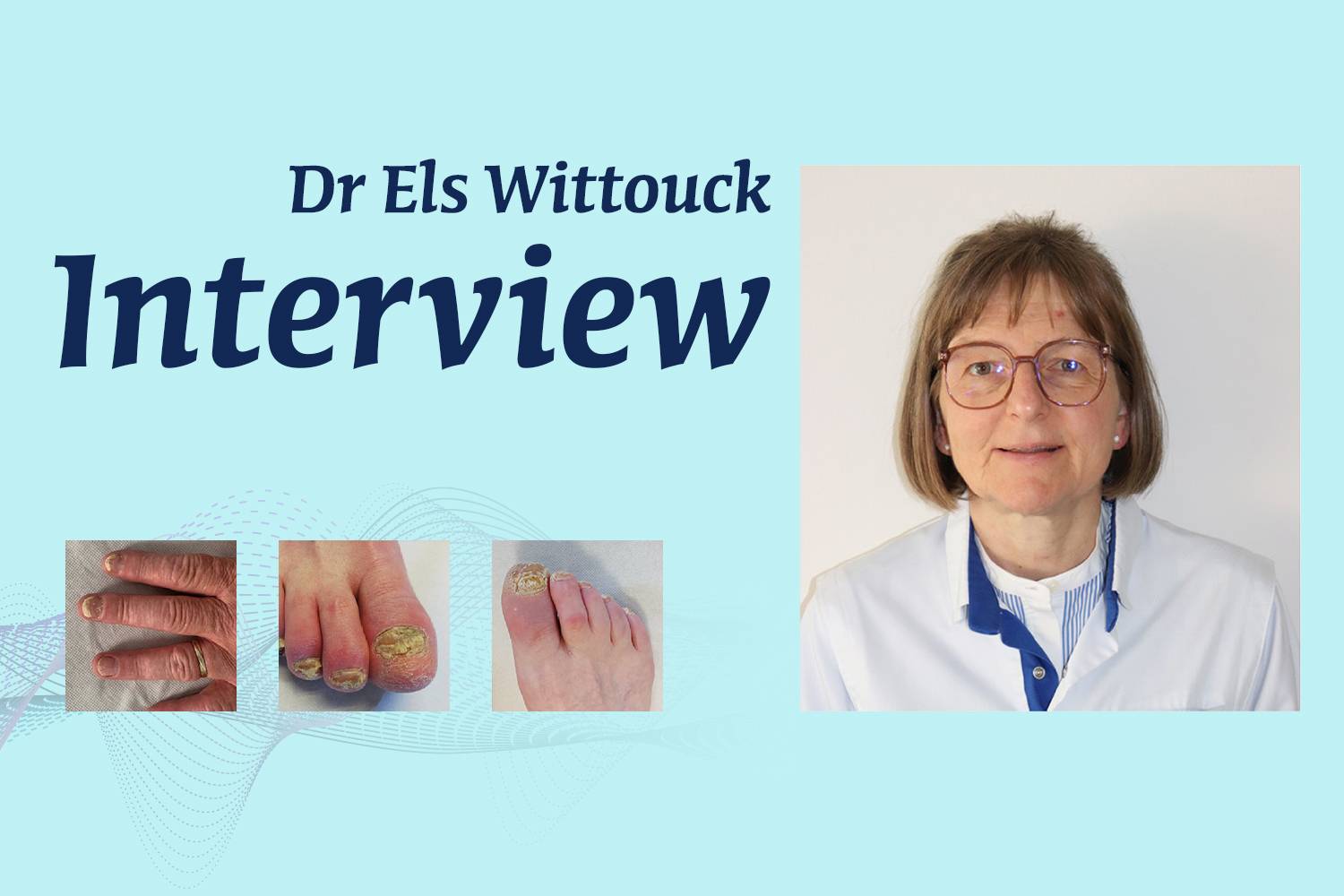 Dermatologie et rhumatologie&nbsp;: étude de cas illustrant la régression du psoriasis unguéal et l'inhibition des interleukines 17A et 17F par le bimekizumab.